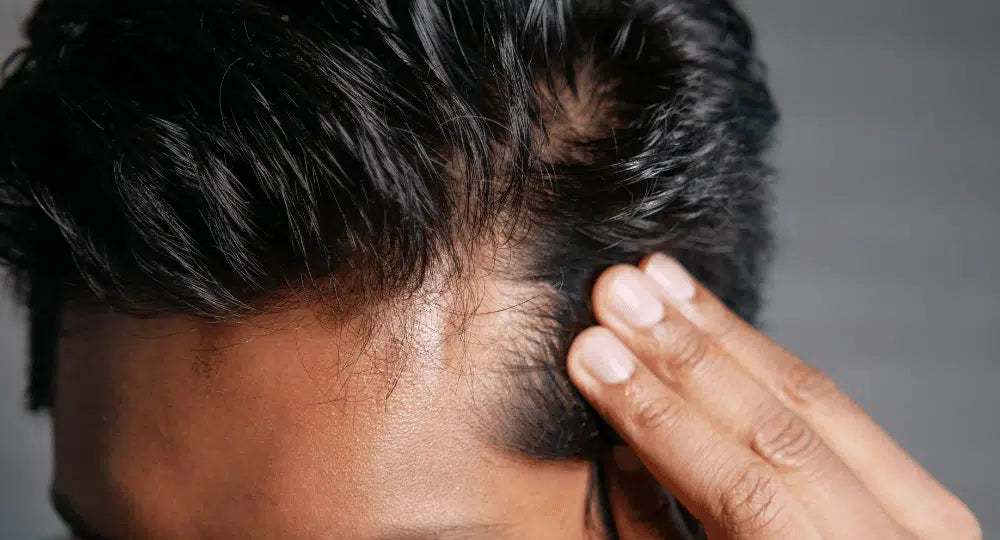 Ursachen für Haarausfall und natürliche Heilmittel